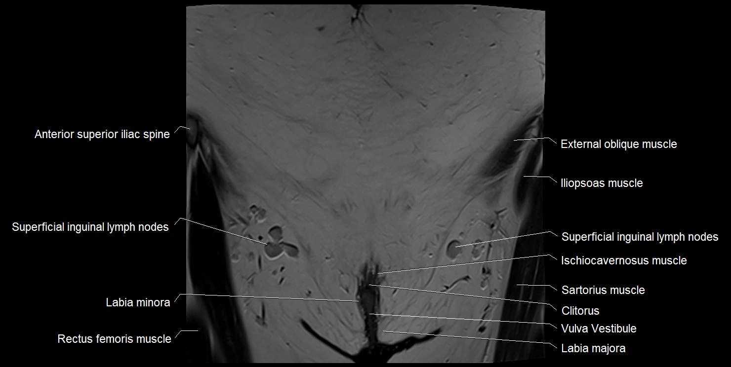 female pelvis coronal cross sectional anatomy image 3.webp